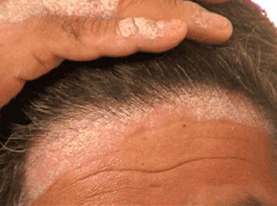 Scalp and Hair Disorder Treatment Program – Scalp & HAir Loss Therapy